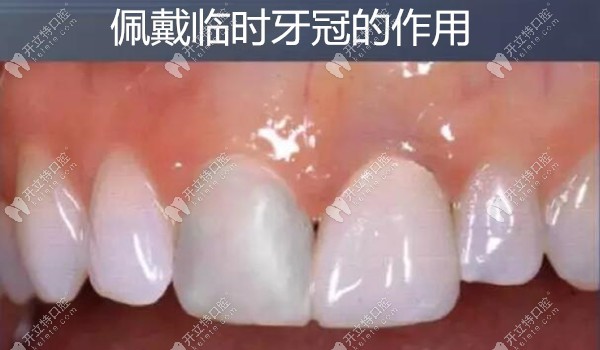 佩戴臨時(shí)牙冠的作用和制作方法,這里應(yīng)有盡有