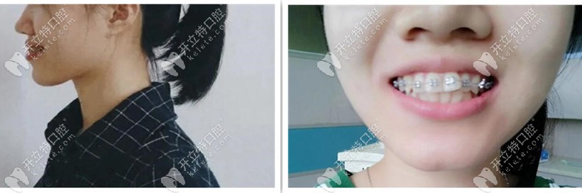 牙套兩個(gè)月側(cè)臉，嘴還是突