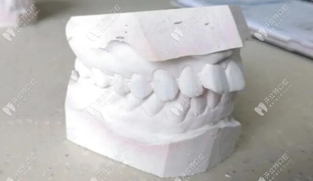 門牙有點(diǎn)凸嘴，牙齒不齊