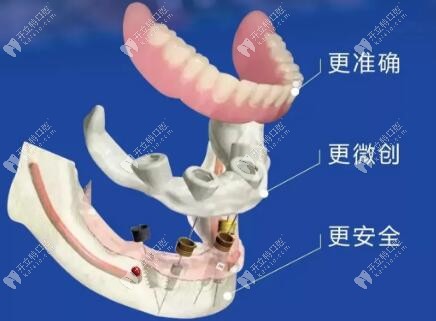 ?老話新談：中諾立得用種植牙好在哪兒？能用多久？